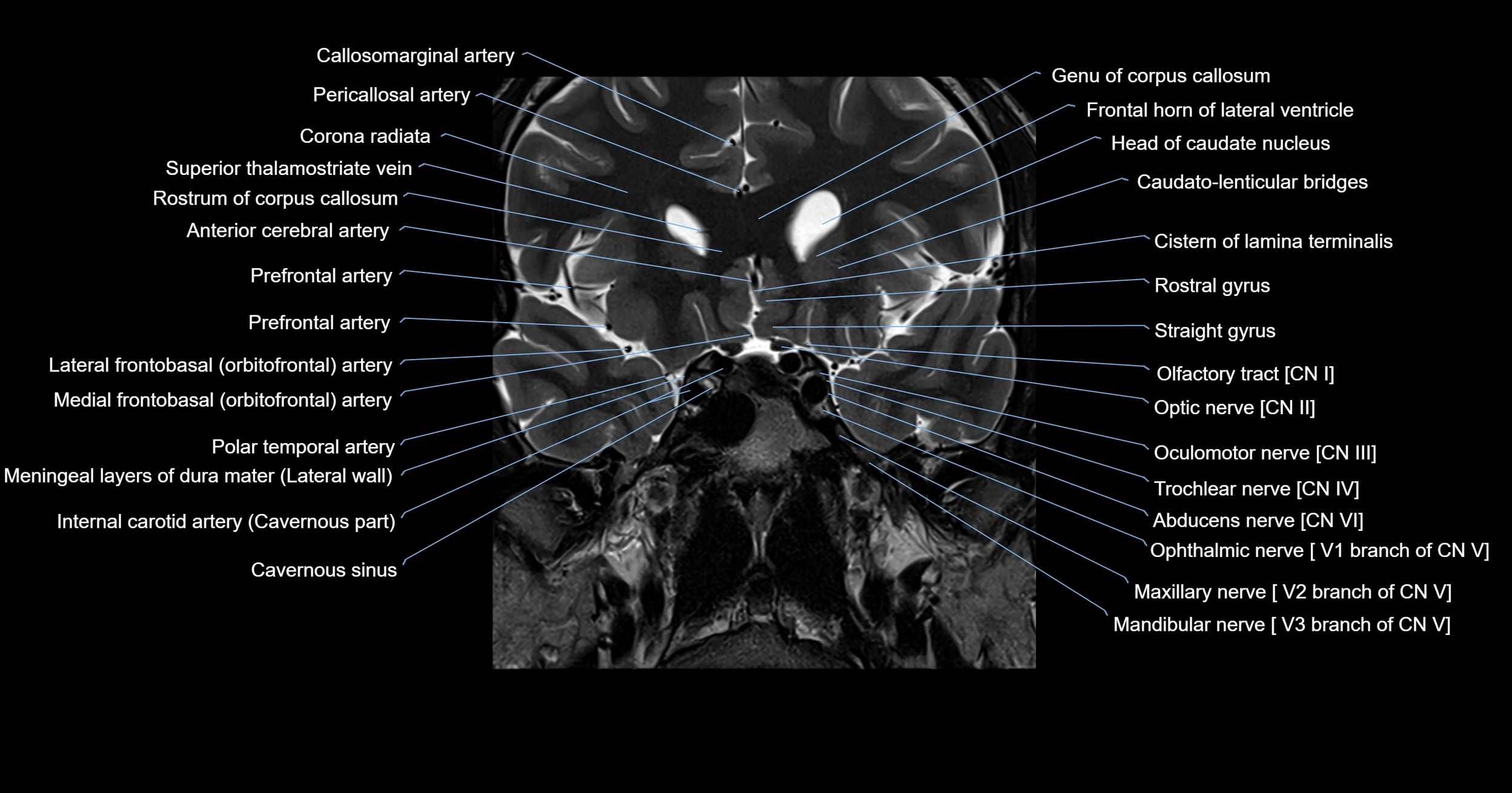 MRI brainstem & basal ganglia anatomy labelled 3T MRI images -img-00001-00008.webp